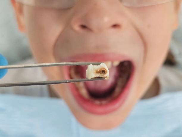 Best Emergency Dental Extractions in Celoron, NY
